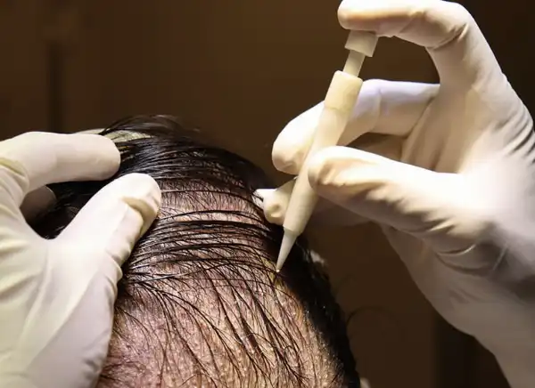 trapianto capelli